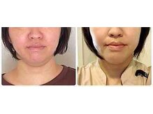 小顔矯正サロン ブルーム/フェイスラインが引き上がる