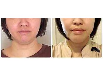 小顔矯正サロン ブルーム/フェイスラインが引き上がる