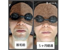 アカラ 美里店(AKALA)の雰囲気（施術を重ねていく度に、効果を実感していただいております。）
