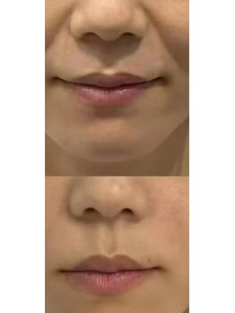 ベリール(BELIRE)の写真/熟練セラピストの手業とマシンでほうれい線やたるみケア。理想の美顔を目指すホウレイ線改善でツルスベ肌！