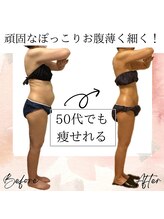 サロン ド ボーテ ラーンジュ 岐阜店(salon de beaut'e L'ange)/ハイパ-ナイフEX2ダイエット痩身