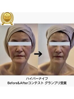 ルミナ ビューティーアンドリラックス(LUMINA Beauty&Relax)の写真/全国ハイパーナイフフェイシャルコンテスト1位受賞★ハイパーナイフ+小顔矯正+吸引70分¥9800◎圧倒的技術力