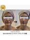 ルミナ ビューティーアンドリラックス(LUMINA Beauty&Relax)の写真/全国ハイパーナイフフェイシャルコンテスト1位受賞★ハイパーナイフ+小顔矯正+吸引70分¥9800◎圧倒的技術力