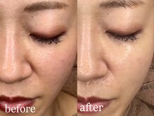 ホワイトアクア 明石店(WHITE AQUA)/ララピール/兵庫/明石/毛穴/小顔