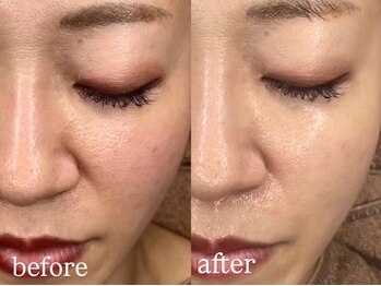 ホワイトアクア 明石店(WHITE AQUA)/ララピール/兵庫/明石/毛穴/小顔