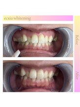 エクシアホワイト 広島袋町店/ホワイトニングビフォーアフター