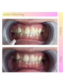 エクシアホワイト 広島袋町店/ホワイトニングビフォーアフター
