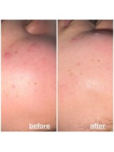 ミニョン(mignon)/赤み気になる人！