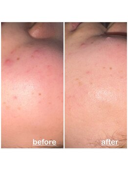 ミニョン(mignon)/赤み気になる人！