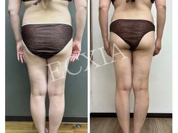 エクシア(ECXIA)/