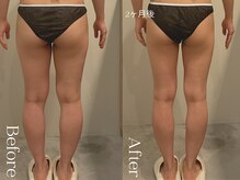 ユーフォリア グロウ(euphoria glow)/｛ ラフォス痩身90分 &nbsp;10回　｝