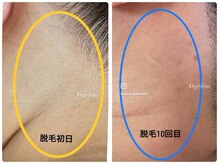 サロン ド アンジェリーナ(Salon de Angelina)/うなじ脱毛12回でかなりキレイに