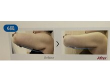 ケーナイン(K nine)/アイスナイフ気になる部位へ照射