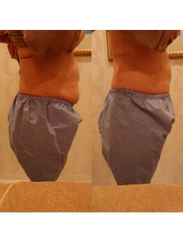 アリュール(ALLURE)/痩身ビフォーアフター2