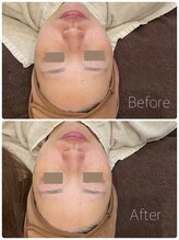 ライエ(Raie)/フェイスワックス脱毛