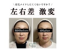 キュープ 鹿児島伊集院店(Qpu)/お顔歪み左右差解消できます！