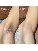 ピーディーエーサロン(PDA salon)/【脇脱毛】
