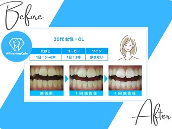 ホワイトニングカフェ 志木店/ホワイトニングbefore after2