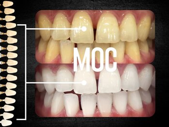 モック 麻布十番(MOC)/ホワイトニング/麻布十番/六本木