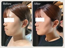 青空 チクシノサロン(SORA CHIKUSHINO SALON)/レモンボトルですっきり小顔#2