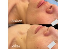 リノ(Lino)/陶肌before after