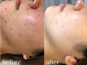 グレイティア(gratia)/光フォト&バクテリウムピール