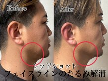 アンドエス 六本木(and S.)/フェイスラインのたるみに♪