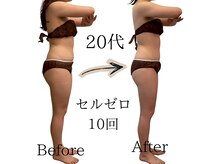 ニコ(nico)/セルライトゼロ/痩身/ダイエット