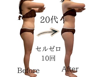 ニコ(nico)/セルライトゼロ/痩身/ダイエット
