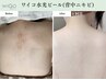 ダウンタイムが少ない【ブライダルにも大人気】背中ピーリング 60分 ¥16,500