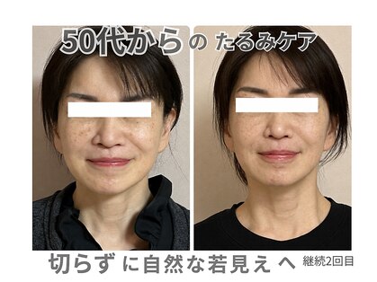 ベルソー(Berceau)の写真
