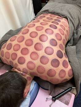 仁接骨院 じん鍼灸治療院/カッピング施術例