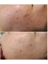 ウォーマル(warmaL)/ハーブピーリング