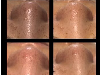 ベルドア(Bell Door)/毛穴ケア集中トリートメント