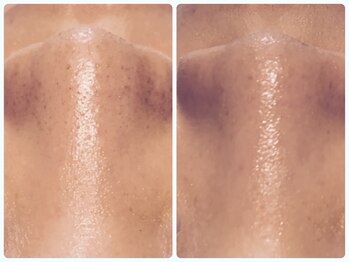 ベルドア(Bell Door)/皮脂/角栓/黒ずみ毛穴