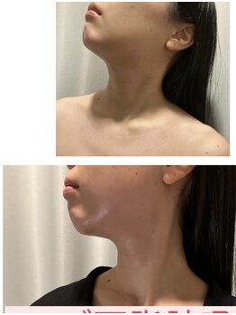 アヌヘア(Anuhea)/京都で1番のインディバ術ケア