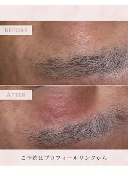 ビューティーサロンレモン(Lemon)/眉毛の電気脱毛