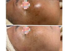 トータルビューティー ココ(Total Beauty CoCo)/【シミケア症例】くすみ・乾燥肌