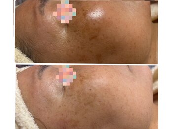 トータルビューティー ココ(Total Beauty CoCo)/【シミケア症例】くすみ・乾燥肌