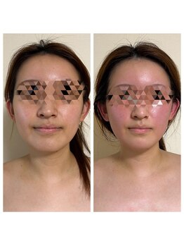 ヨサパーク リアン(YOSA PARK Lien)/モニター様before→after/痩身