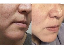 ポカポカ(pokapoka)/肌質改善トリートメント