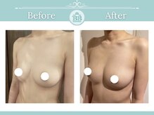 美人バスト 福岡店/バストアップ ◇症例◇