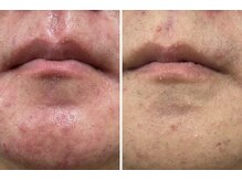 ホッコリ 段原店(HOKKORI)/花粉荒れ・肌荒れには毛穴洗浄