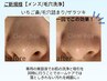 ご新規様限定【メンズ/毛穴洗浄】通常価格¥5,000→¥4,000