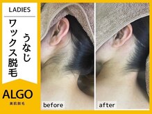 アルゴ 敦賀店(ALGO)/10代女性３回目　WAX+光脱毛