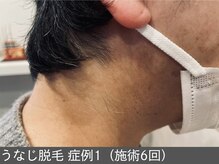 オアシスラグーン(OASIS LAGOON)/うなじ脱毛（症例1 施術6回）