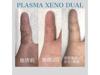 ビーダブリュー(BW...)/☆プラズマゼノデュアル施術例☆