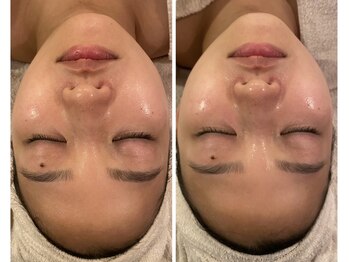 うつくし痩身 美サロン ゼットワン(Z-ONE)/カーボキシーセラピbeforeafter