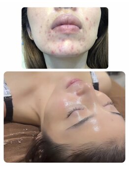 ウィズルーチェ つくばみどりの店(with luce)/ニキビケア「相談してよかった」