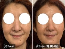 ココモンド(COCOMONDO)/幹細胞フェイシャル/エイジング